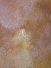 Amazingly small scar on chest is all that is left of wound in previous photograph.